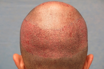 GENERAL INFORMATION ABOUT HAIR TRANSPLANT