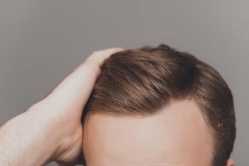 WHAT IS FUE HAIR TRANSPLANT AND HOW IS IT APPLIED?