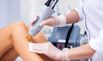 LASER EPILATION