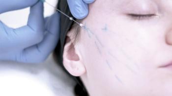 NON-SURGICAL  AESTHETIC PROCEDURES / FACE LIFT WITH THREADS 