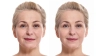 DERMAL-FILLER-BEHANDLUNGEN