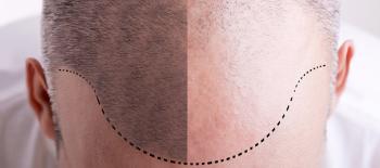 ALLGEMEINE INFORMATIONEN ZUR HAARTRANSPLANTATION