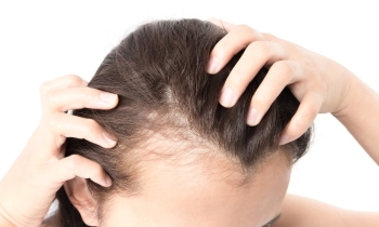 ما هي زراعة الشعر بالاقتطاف وكيف يتم تطبيقها؟