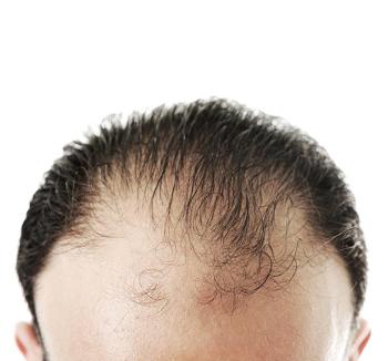 ANDROGENETİK ALOPESİ - ERKEK TİPİ KELLİK