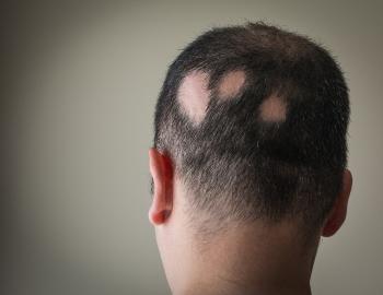 ALOPESİ AREATA -SAÇ DÖKÜLMESİ