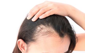 Kadınlarda Saç Dökülmesinin Nedenleri Nelerdir? | Medipol Sağlık Grubu