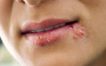 HERPES SİMPLEKS / UÇUK NEDİR ?